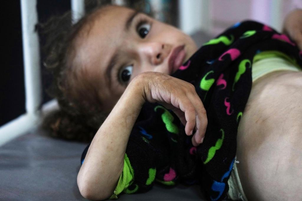 El hospital principal de Gaza está abrumado con niños con dolor por desnutrición
