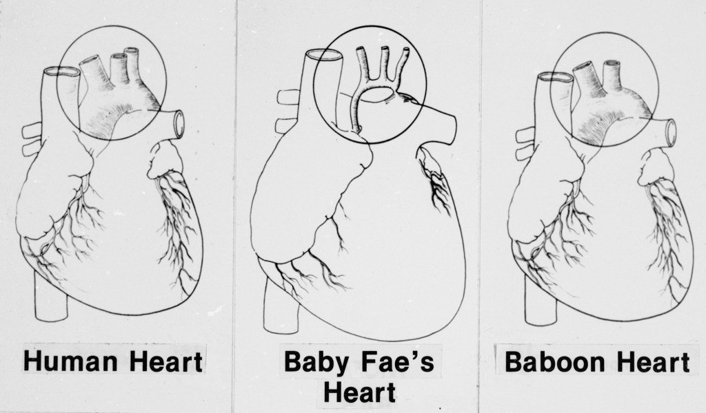 Hoy en la Historia: 26 de octubre, Recién nacido recibe corazón de babuino en trasplante experimental